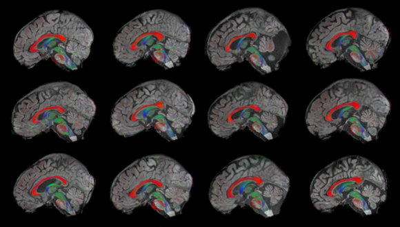 The TAU Brain-MRI Bank Project